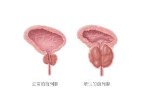 河池前列腺肥大有哪些危害 河池前列腺肥大有哪些危害