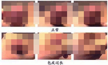 如何判断儿童是否包皮过长呢？