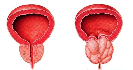 前列腺囊肿会传染